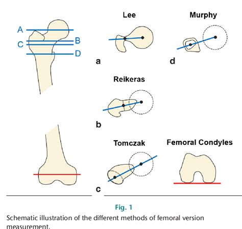 Figure 1 From Coxa Valga And Antetorta Increases Differences Among