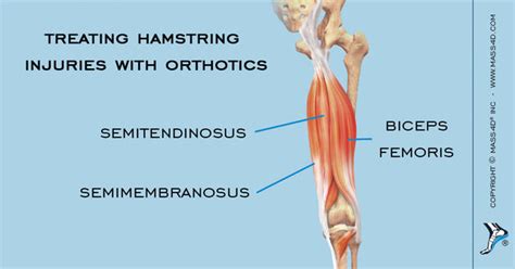 How To Treat Hamstring Injuries With Orthotics Mass4d® Foot Orthotics
