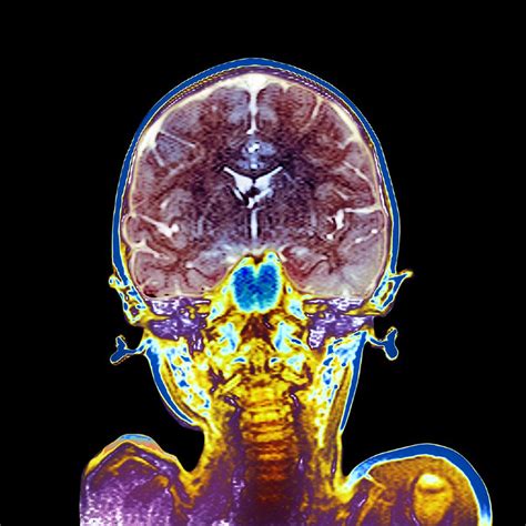 Childs Brain Mri Scan Photograph By Du Cane Medical Imaging Ltd Pixels