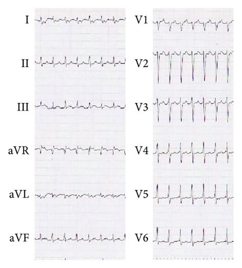 Twelve Lead Electrocardiogram Ecg A And Chest X Ray On Admission