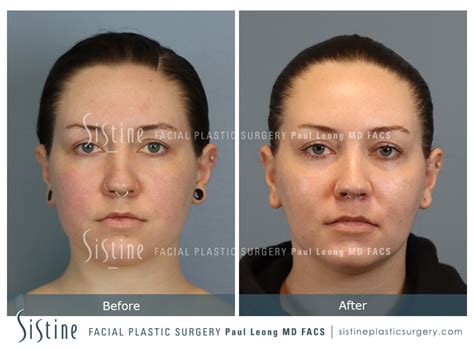 Buccal Fat Removal Before And After Sistine Facial Plastic Surgery