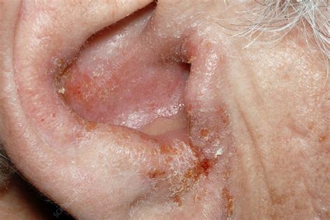 outer ear infection stock image m157 0089 science photo library