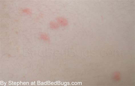 Bedbug Bites Discussion Pg 3