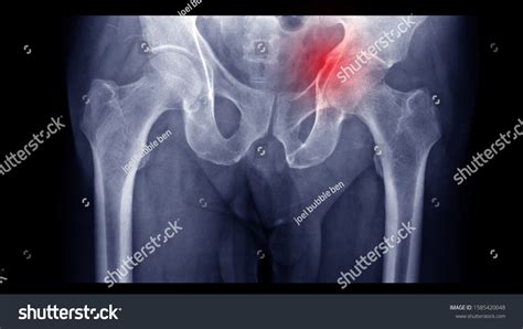 Acetabulum Over 436 Royalty Free Licensable Stock Photos Shutterstock