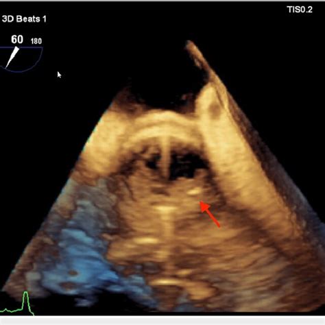 Tee Showing Perivalvular Abscess On An Aortic Prosthetic Valve Arrow