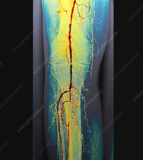 Blocked Leg Artery Angiogram Stock Image C0489295 Science Photo