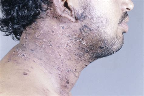 Hivaids Related Skin Conditions