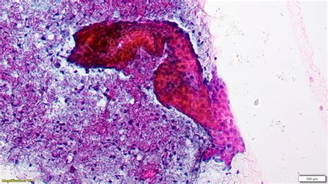 Pathology Outlines Nonproliferative Fibrocystic Changes