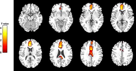 Multiple Axial Views Of T1 Weighted Brain Mri Sequences Superimposition