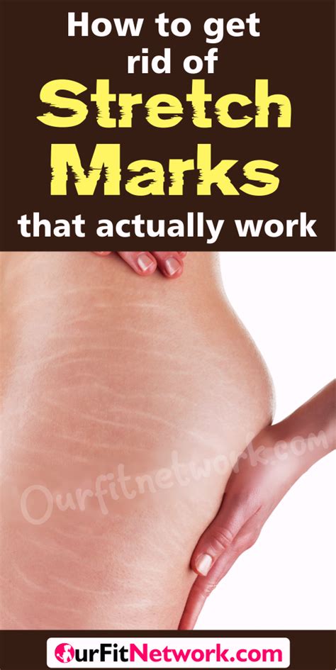 How To Get Rid Of Stretch Marks That Actually Work Stretch Mark