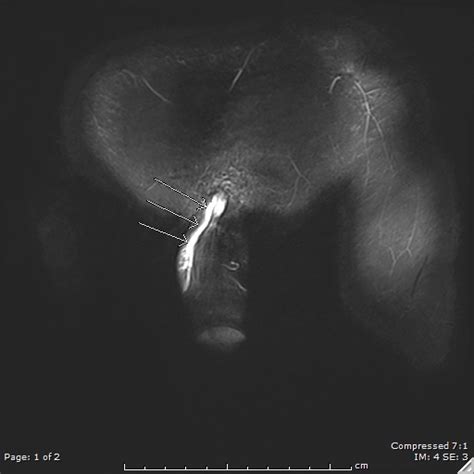 In axilla, this condition is known as axillary web syndrome. Images | Radiopaedia.org