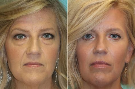 Blepharoplasty Photos Chevy Chase Md Patient 23428
