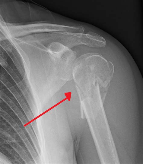 Proximal Humerus Fracture Ao 463327 Proximal Humerus Fracture Ao