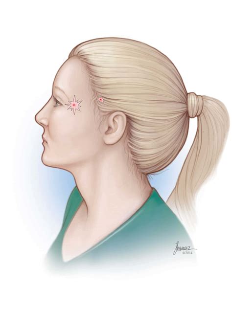 Migraine Surgery For Relief Surgeon Procedure