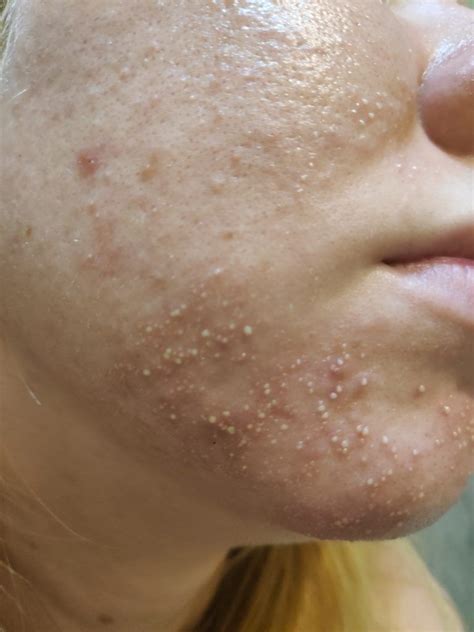 From Fungal Acnefolliculitis To Clear Skin With Pictures Skin