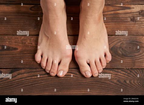 Hllux Valgus On Female Legs Close Up On Wooden Background Foot Joint