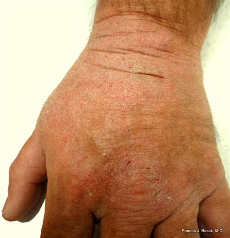 Hand Eczema Basuk Dermatology