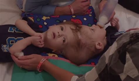 These Conjoined Twins Were Finally Separated Thanks To A Rare Surgery