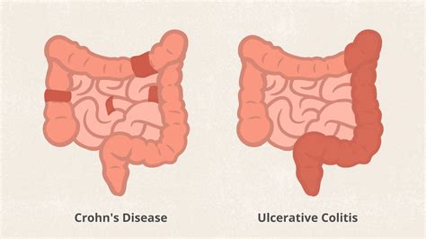 8 Superfoods For Crohns Disease Everyday Health