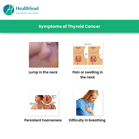 Thyroid Cancer Symptoms And Treatment Hematologyoncology Healthsoul