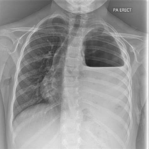 Chest X‐ray Showing Left‐sided Pleural Air‐fluid Level With Mediastinal
