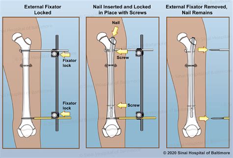 Fixator Assisted Nailing Fan International Center For Limb Lengthening