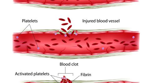 Hemostasis Blood Vessel Injury Injury Choices