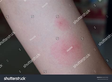 Ill Allergic Arm Rash Dermatitis Eczema Stock Photo Edit Now 692291950