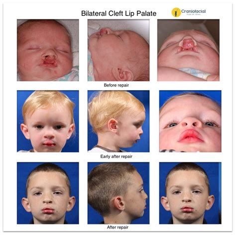 Albums 105 Images Cleft Palate Before And After Surgery Photos Stunning