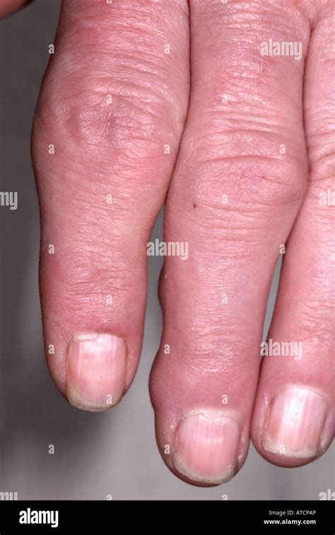 Swollen Fingers Hi Res Stock Photography And Images Alamy
