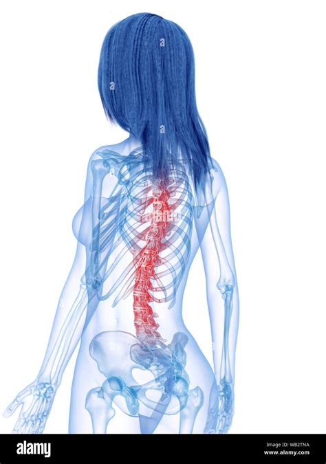 Back Pain Conceptual Illustration Stock Photo Alamy