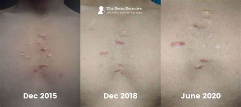 Best Silicone Scar Sheets 10 Ways To Fade Scars For Good 2021 The