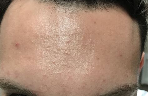 Small Bumps All Over Forehead Folliculitis General