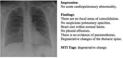 Beautiful How To Write Normal Chest X Ray Report A Security Incident