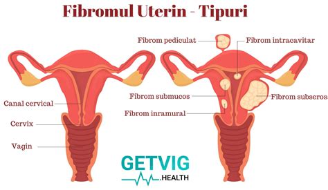 Fibromul Uterin Cauze Simptome Si Metode De Tratament Hot Sex Picture