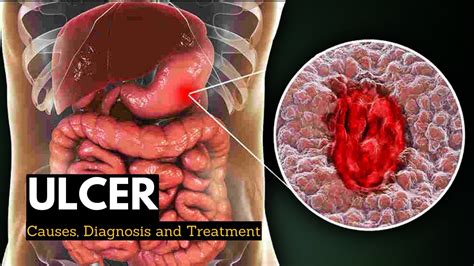 Ulcer Causes Signs And Symptoms Diagnosis And Treatment Youtube