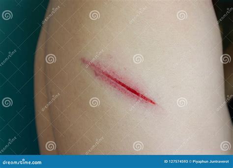 Wound On Back Fresh Wounds Stock Image Image Of Accident Person