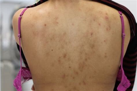 6 Ways To Get Rid Of Acne Scars On Back Howhunter