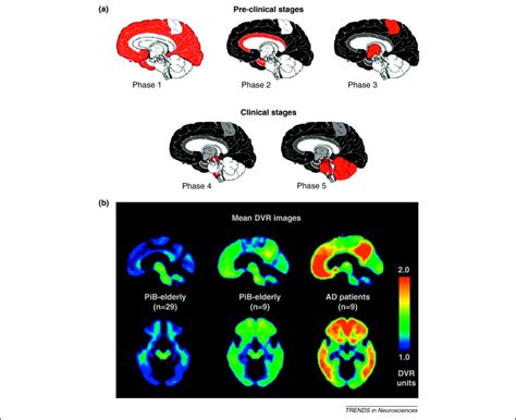 Neuroimaging Markers For The Prediction And Early Diagnosis Of