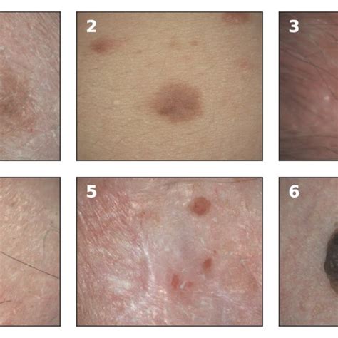 Examples Of Melanoma And Non Melanoma Skin Cancer Taken In A Clinical