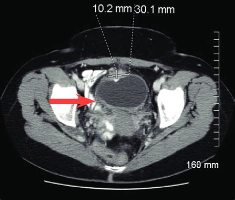 Ct Scan Showing Bladder Wall Thickening Arrow And Decrease In Tumor