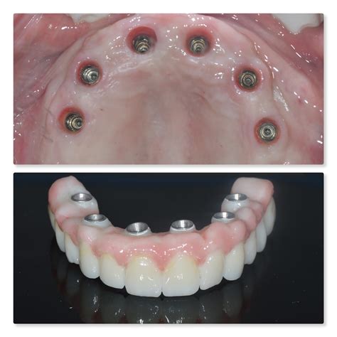 Full Arch Same Day Teeth Dental Implants Leeds Infinity Dental Clinic