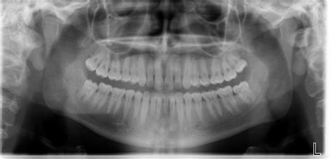 OPG 6 | Buyxraysonline