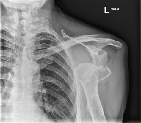 A Case Of Iatrogenic Proximal Humeral Head Fracture Orthogate