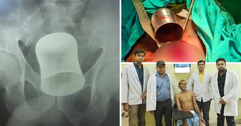 Man Says Metal Cup Removed From Anus Was Put There By Muggers Metro News