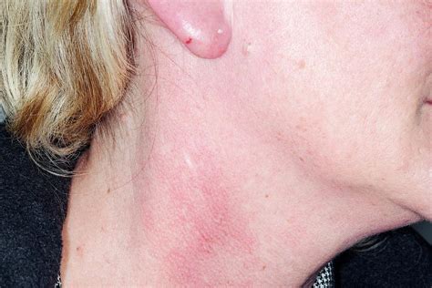 Cellulitis On The Earlobe Photograph By Dr P Marazzi Science Photo