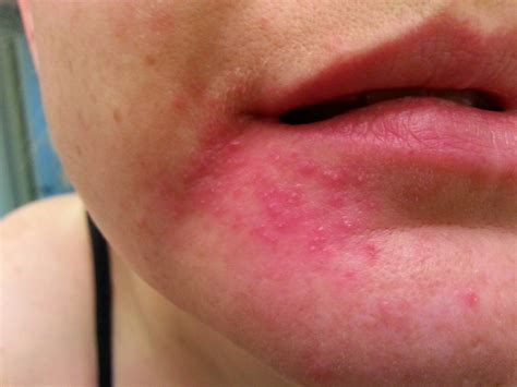 How To Treat Perioral Dermatitis Causes And Natural Care Treatment