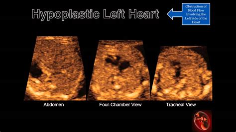 Fetal Echocardiography Hypoplastic Left Ventricle Youtube