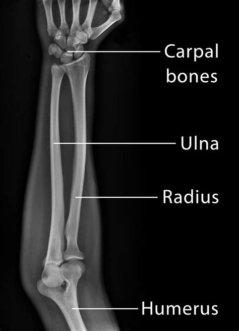 Ulna Definition Location Anatomy Functions Labeled Diagram