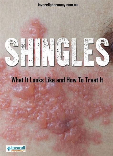 Shingles What It Looks Like And How To Treat It